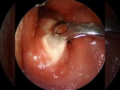 ปัจจุบัน ≤1.5mA อาร์โตรสโกปี RF พลาสมา แดงอุปกรณ์ผ่าตัด ไหล่ คอ เข่า