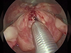 ปัจจุบัน ≤1.5mA อาร์โตรสโกปี RF พลาสมา แดงอุปกรณ์ผ่าตัด ไหล่ คอ เข่า